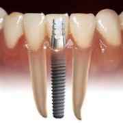 dental implant cost in mumbai
