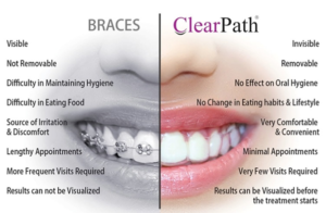 Clear Aligners – Dr. Krinita Motwani Dental Clinic