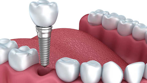 11 Methods Of dental laminates Domination