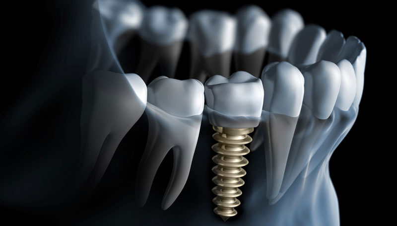 Best Dental implants in khar