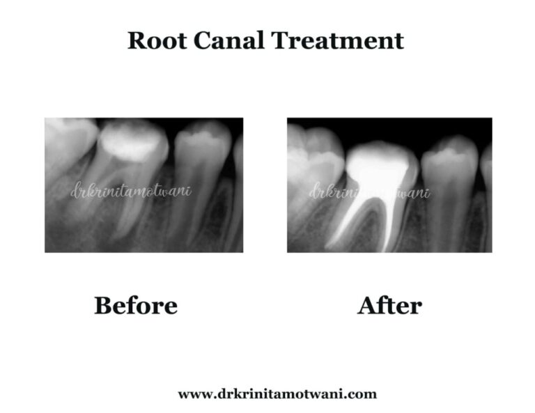 Root Canal Treated (1)