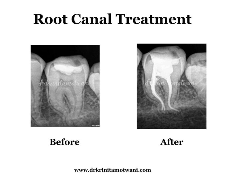 Root-Canal-Treated-5