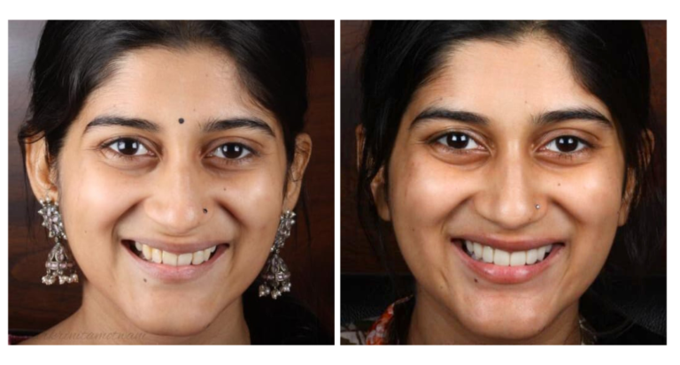 smile designing treatment