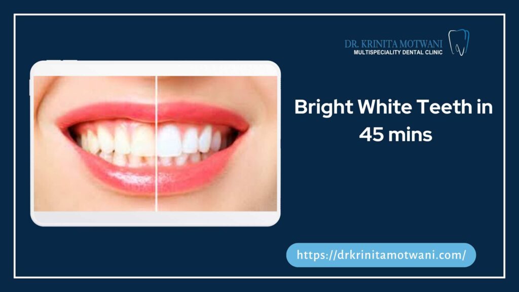 Bright White Teeth in 45 mins