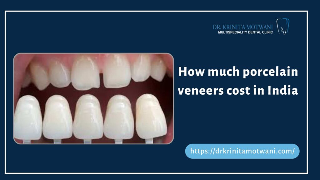 veneers cost in india