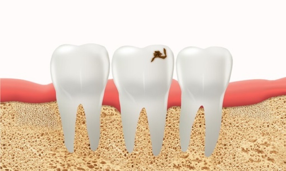 Cavity in Teeth