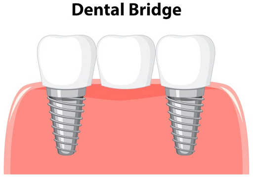 Benefits and Drawbacks of Dental Implants