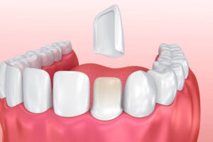 dental porcelain veneer treatment in Mumbai