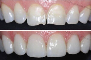 dental porcelain veneers