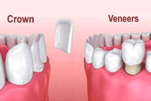 dental porcelain veneers treatment