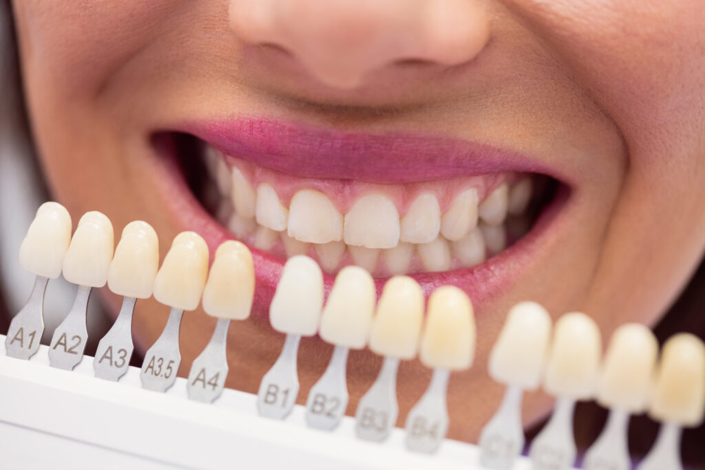 Dental Porcelain Veneers Treatment In Mumbai
