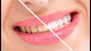 Sensitive Teeth Whitening