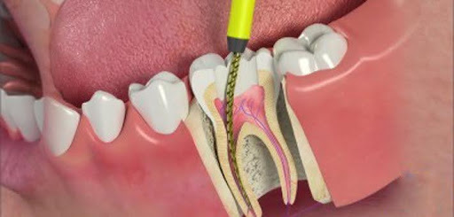 Specialist for Root Canal Treatment in Mumbai